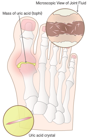 Illustration of gout of the big toe, illustration depicts a microscopic view of uric acid crystals, and a microscopic view of the synovial joint capsule with uric acid crystals accumulating in the joint.