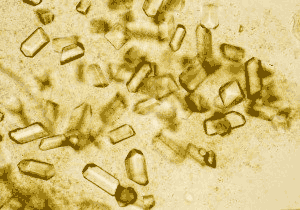 Microscopic view of uric acid crystals, the cause of gout.