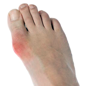 Photo of a foot exhibiting signs of a gout attack. The red and inflamed big toe joint is the site of the attack.